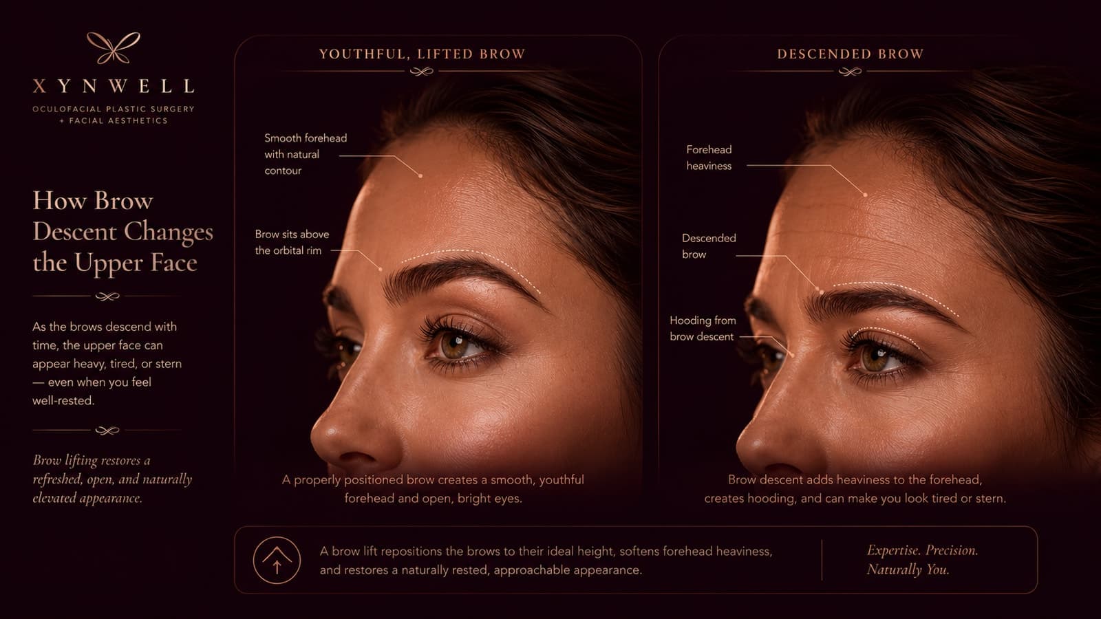 Side-by-side illustration of a youthful lifted brow (smooth forehead, brow resting above the orbital rim) versus a descended brow (forehead heaviness and upper-eyelid hooding caused by brow descent).