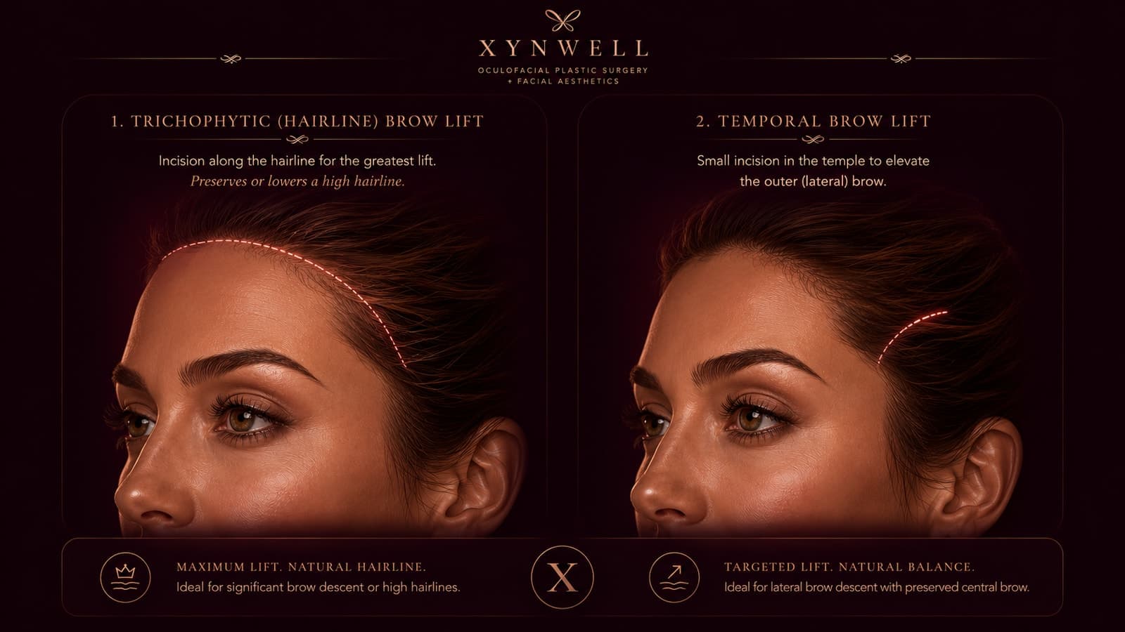 The two brow-lift techniques side by side: a trichophytic (hairline) brow lift uses an incision along the hairline for maximum lift while preserving or lowering a high hairline, and a temporal brow lift uses a small incision in the temple to elevate the outer (lateral) brow.