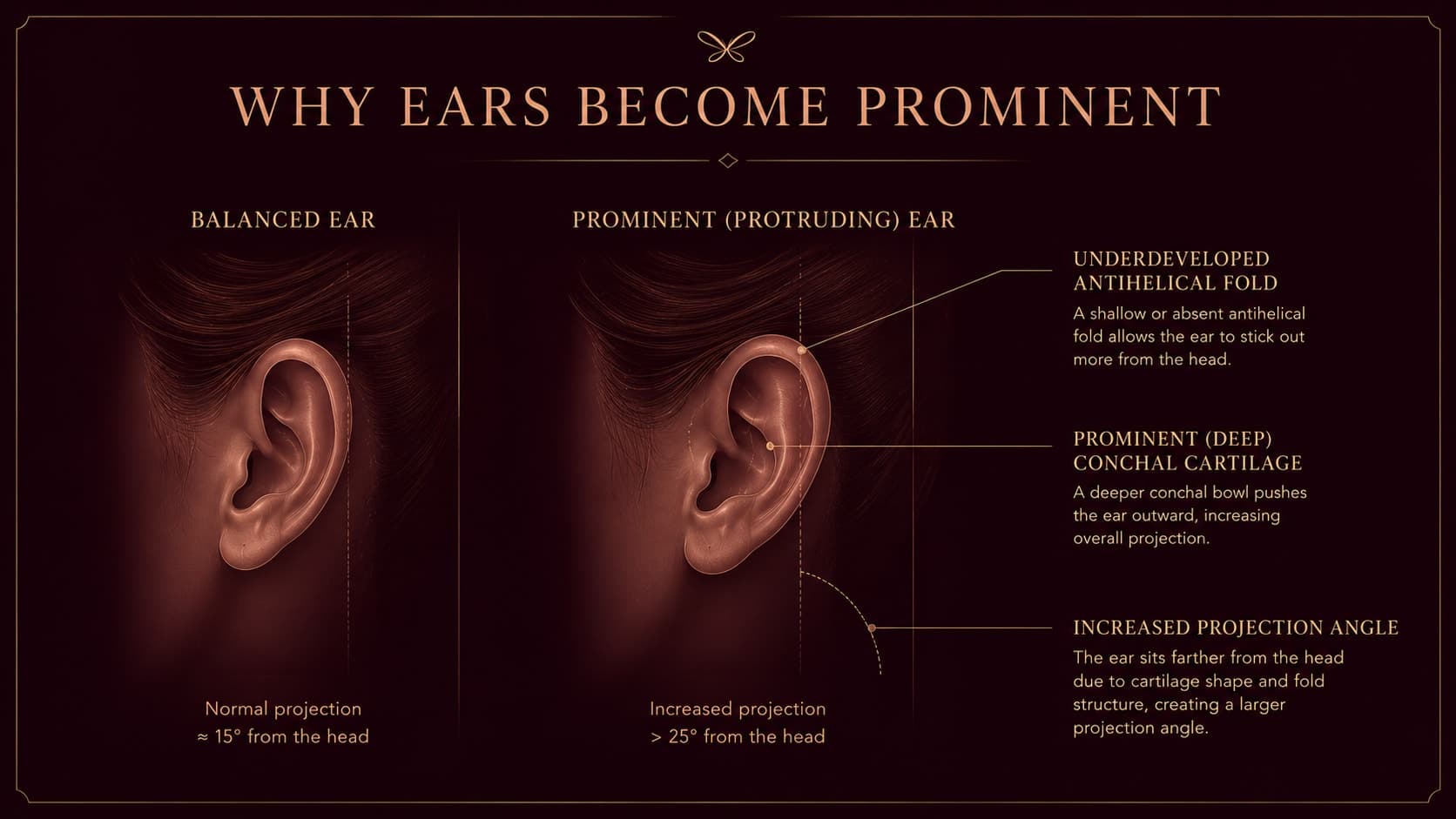 Illustration comparing a balanced ear (normal projection, about 15 degrees from the head) with a prominent, protruding ear, labeling the underdeveloped antihelical fold, prominent deep conchal cartilage, and increased projection angle.