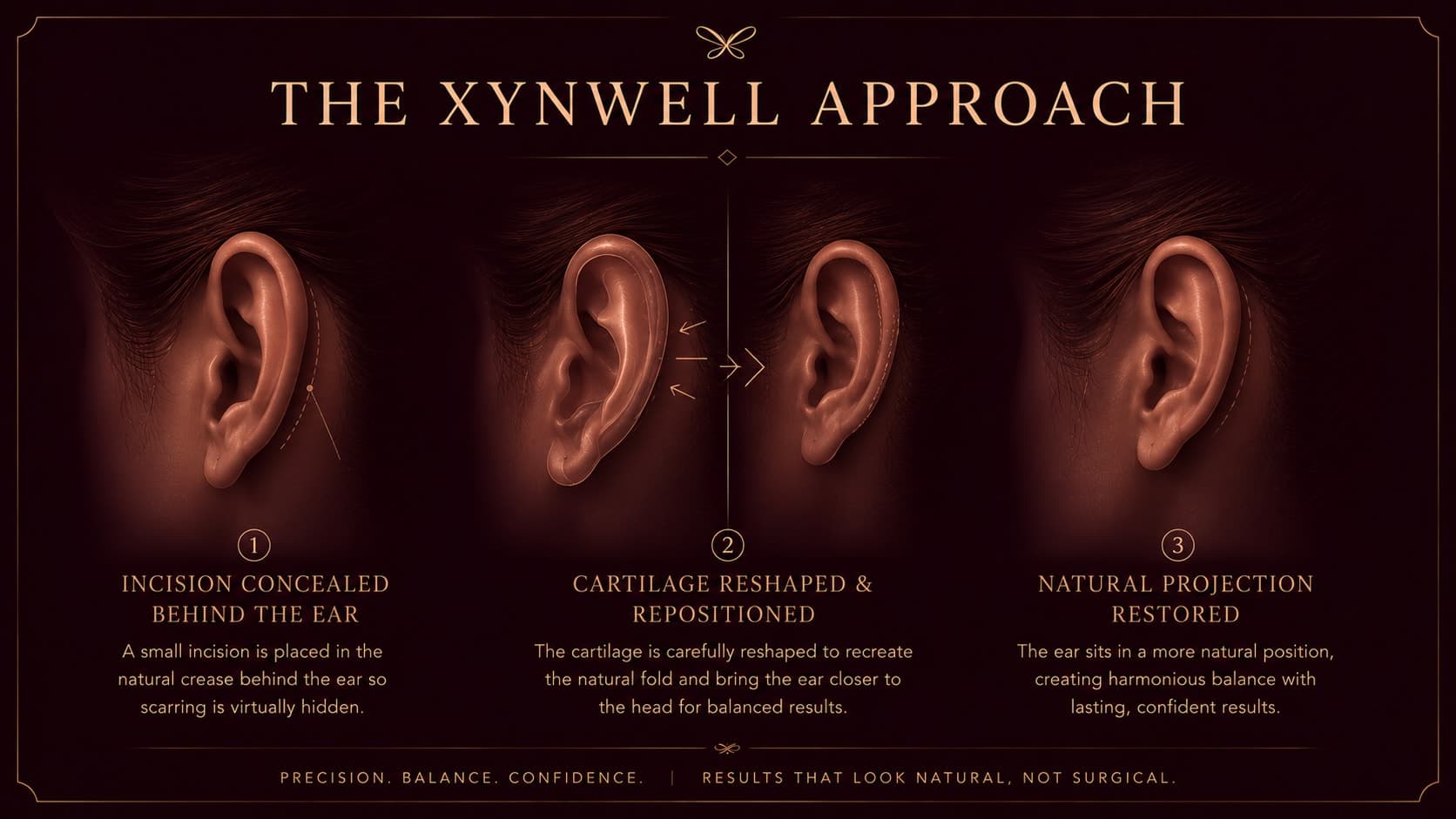 Three-step illustration of the Xynwell otoplasty approach: an incision concealed behind the ear, the cartilage reshaped and repositioned closer to the head, and natural projection restored for a balanced result.