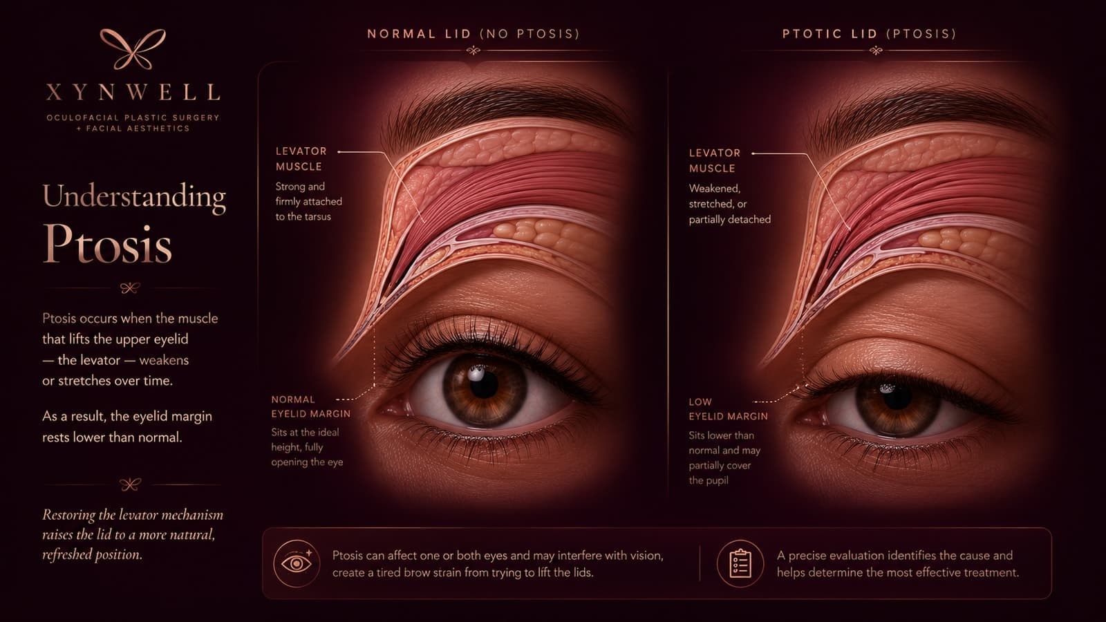 Side-by-side illustration of a normal upper eyelid (a strong levator muscle holds the lid at its normal margin) versus a ptotic eyelid (a weakened, stretched levator muscle lets the eyelid margin sit low).