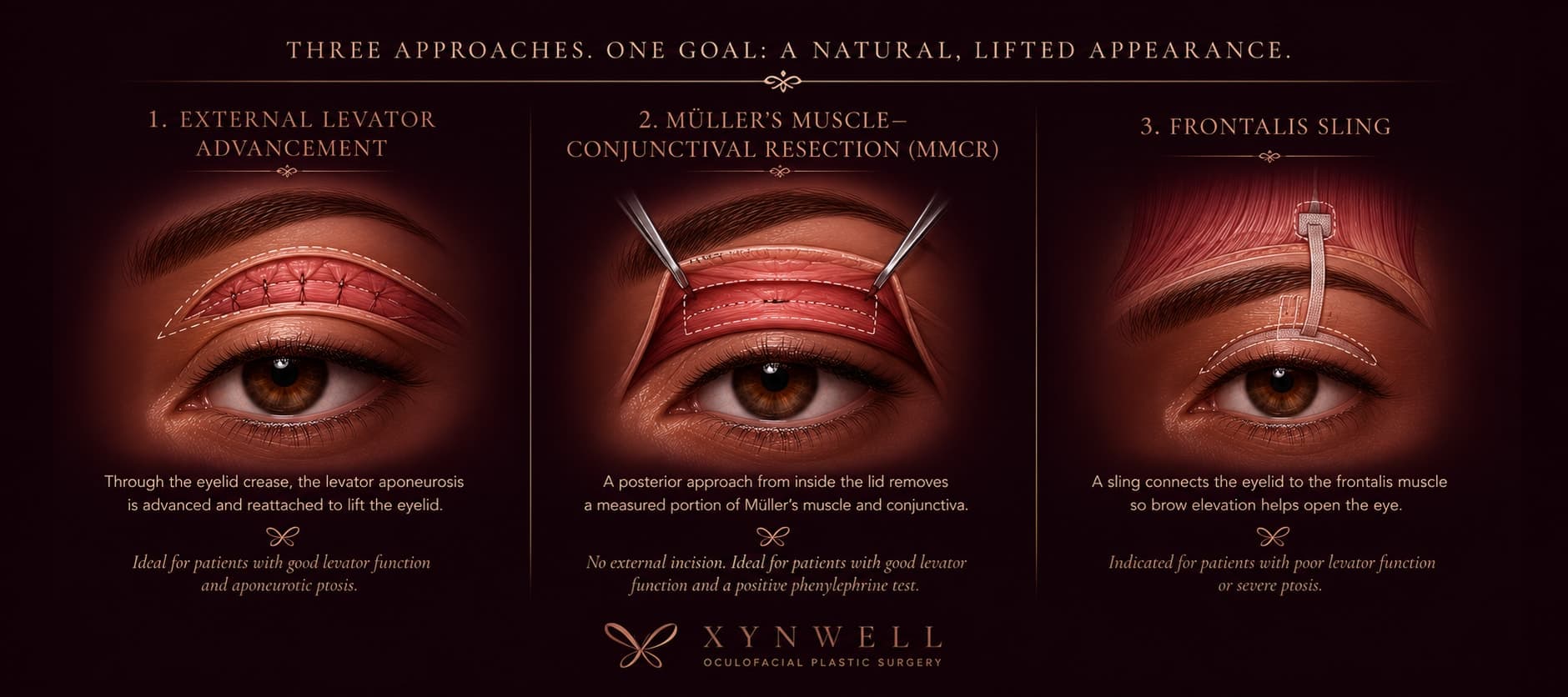 The three ptosis-repair techniques side by side: external levator advancement (the lifting muscle is reattached through the eyelid crease), Müller's muscle–conjunctival resection / MMCR (a posterior approach from inside the lid, no external incision), and a frontalis sling (the lid is connected to the brow-lifting muscle).