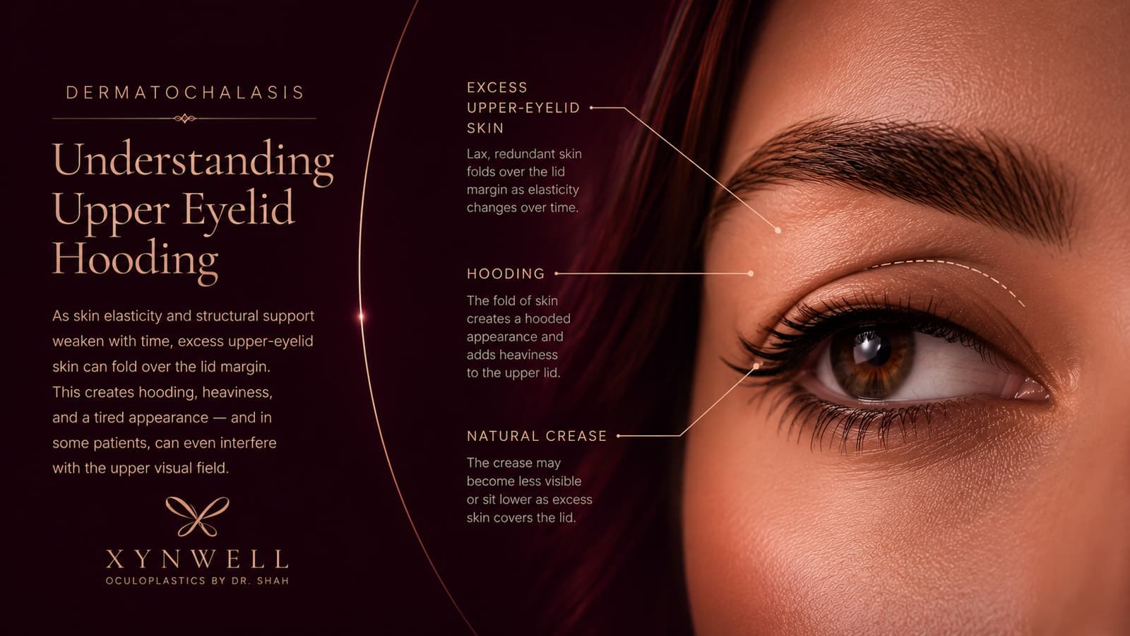 Illustration of the upper eyelid showing how lax, redundant skin folds over the lid margin to create hooding and heaviness (dermatochalasis), with the natural eyelid crease labeled.