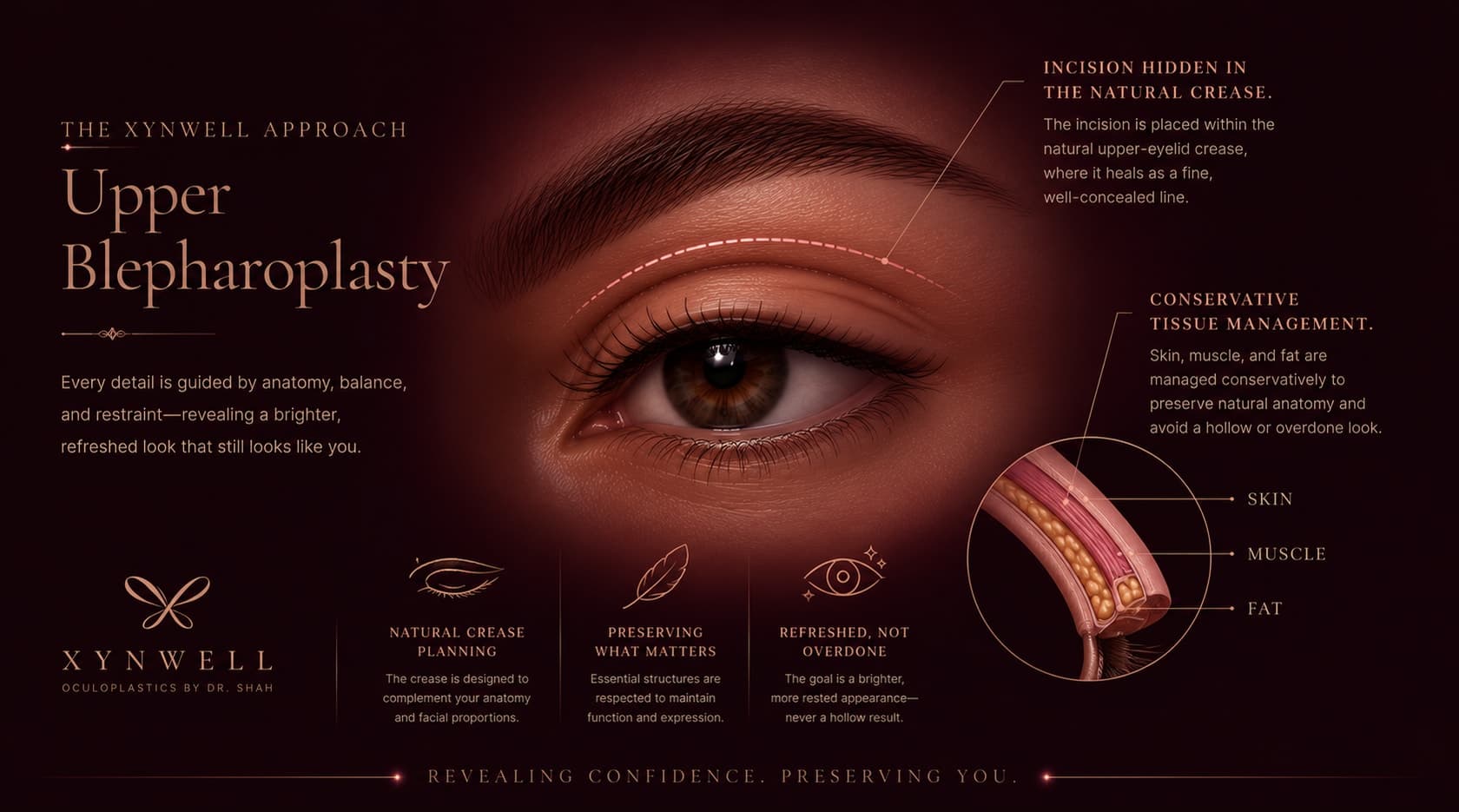 The Xynwell approach to upper blepharoplasty: the incision is hidden within the natural upper-eyelid crease where it heals as a fine line, and skin, muscle, and fat are managed conservatively to preserve natural anatomy and avoid a hollow or overdone result.