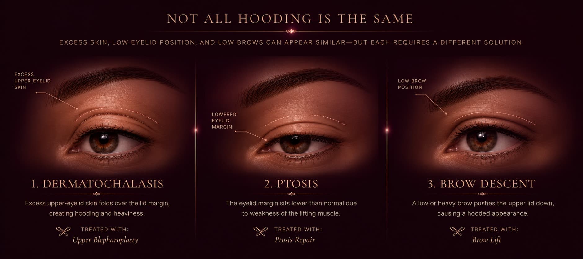 Three side-by-side eye illustrations showing that similar-looking hooding has different causes and treatments: dermatochalasis (excess upper-eyelid skin) treated with upper blepharoplasty, ptosis (a low eyelid margin) treated with ptosis repair, and brow descent (a low brow) treated with a brow lift.