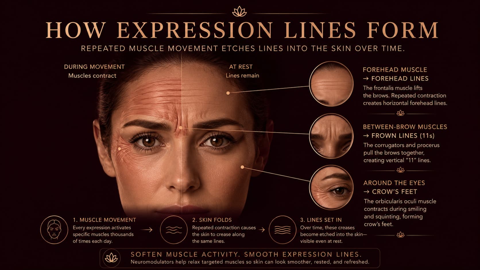 Illustration titled How Expression Lines Form showing how repeated muscle movement etches lines into the skin: the frontalis creates forehead lines, the corrugators and procerus create frown lines (11s), and the orbicularis oculi creates crow's feet, with lines that remain even at rest.