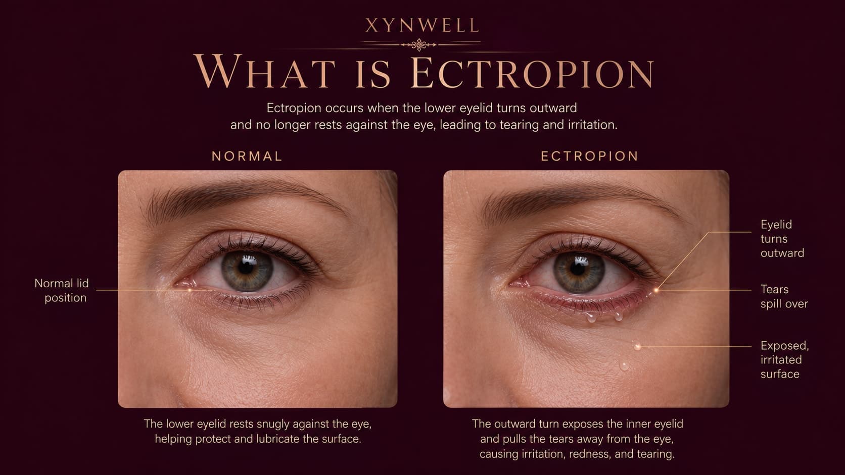 Illustration titled What Is Ectropion comparing a normal lower eyelid resting snugly against the eye with an ectropion eyelid turning outward, causing tears to spill over and the inner eyelid surface to become exposed and irritated.