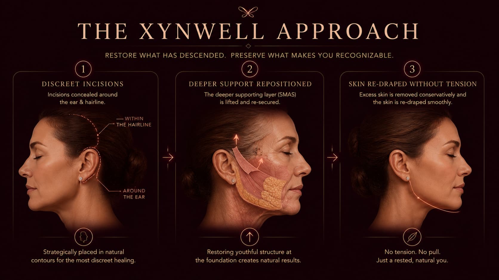 Illustration titled The Xynwell Approach with three steps: discreet incisions concealed around the ear and within the hairline; the deeper support layer (SMAS) lifted and re-secured; and the skin re-draped smoothly without tension for a natural, rested result.