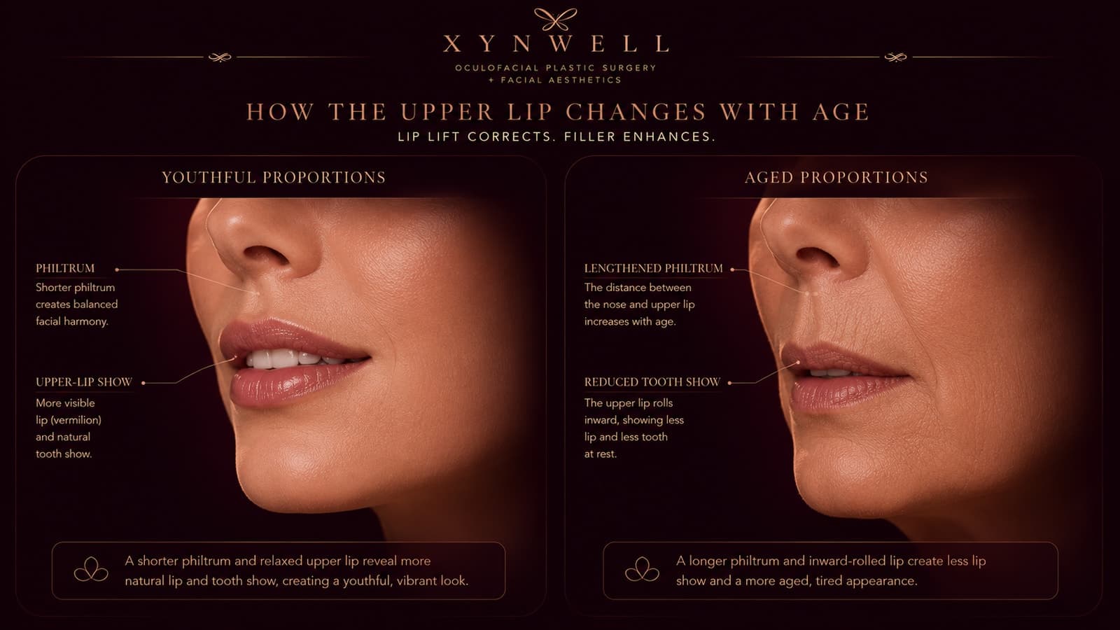 Side-by-side illustration of youthful upper-lip proportions (a shorter philtrum with more lip and tooth show) versus aged proportions (a lengthened philtrum, the lip rolled inward with reduced lip and tooth show).