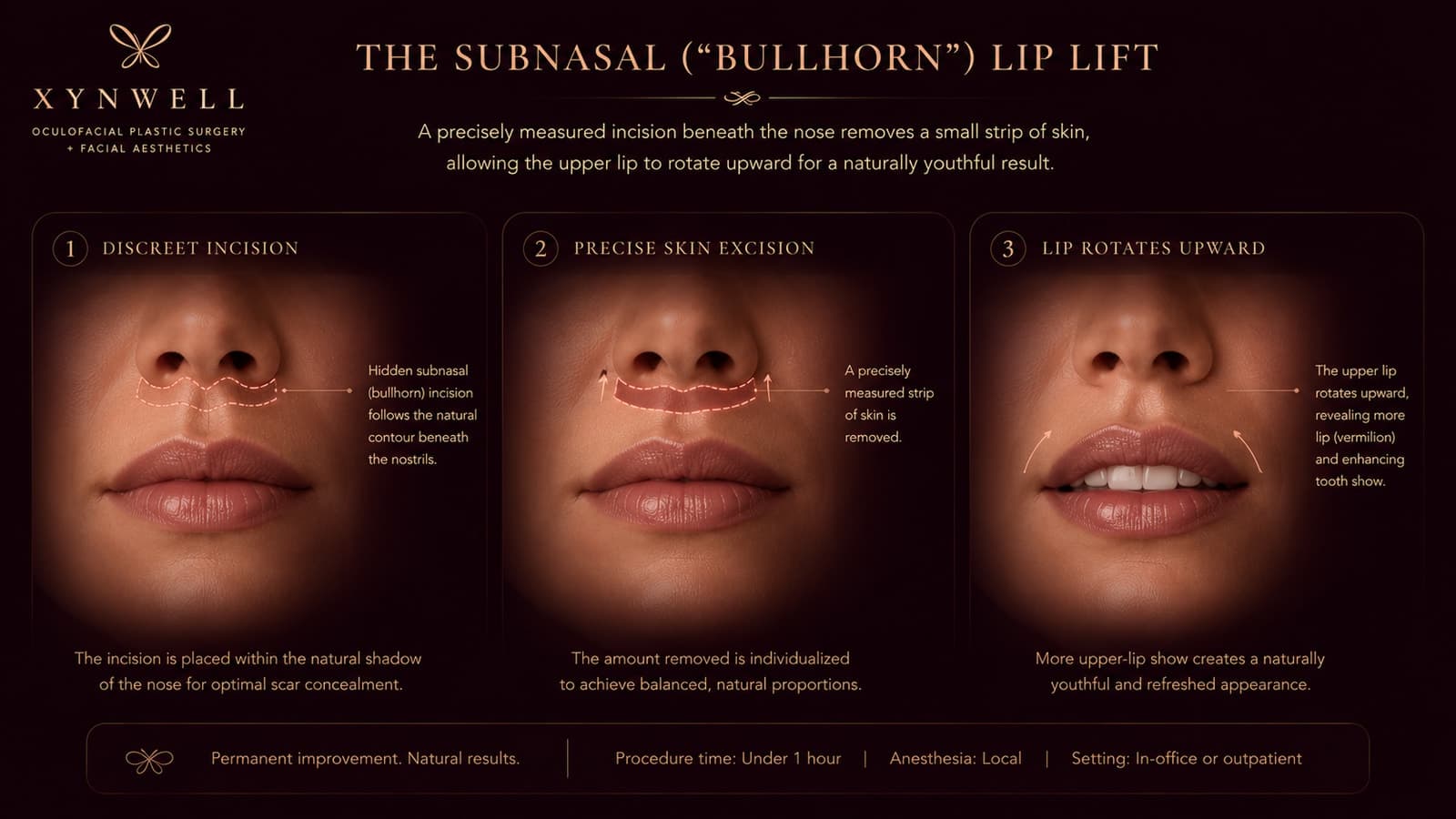 The subnasal bullhorn lip lift in three steps: a discreet incision hidden in the natural shadow beneath the nose, a precise strip of skin removed, and the upper lip rotating upward to reveal more lip and tooth show.
