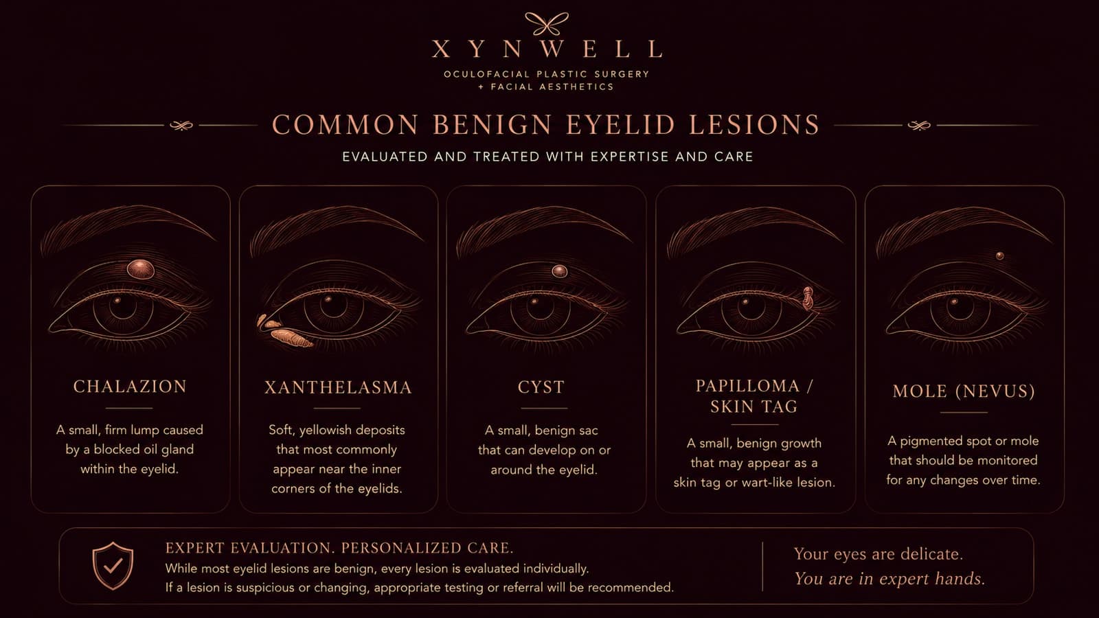 An illustrated reference of common benign eyelid lesions — chalazion, xanthelasma, cyst, papilloma / skin tag, and mole (nevus) — shown discreetly on stylized eyelid art, each with a short description.