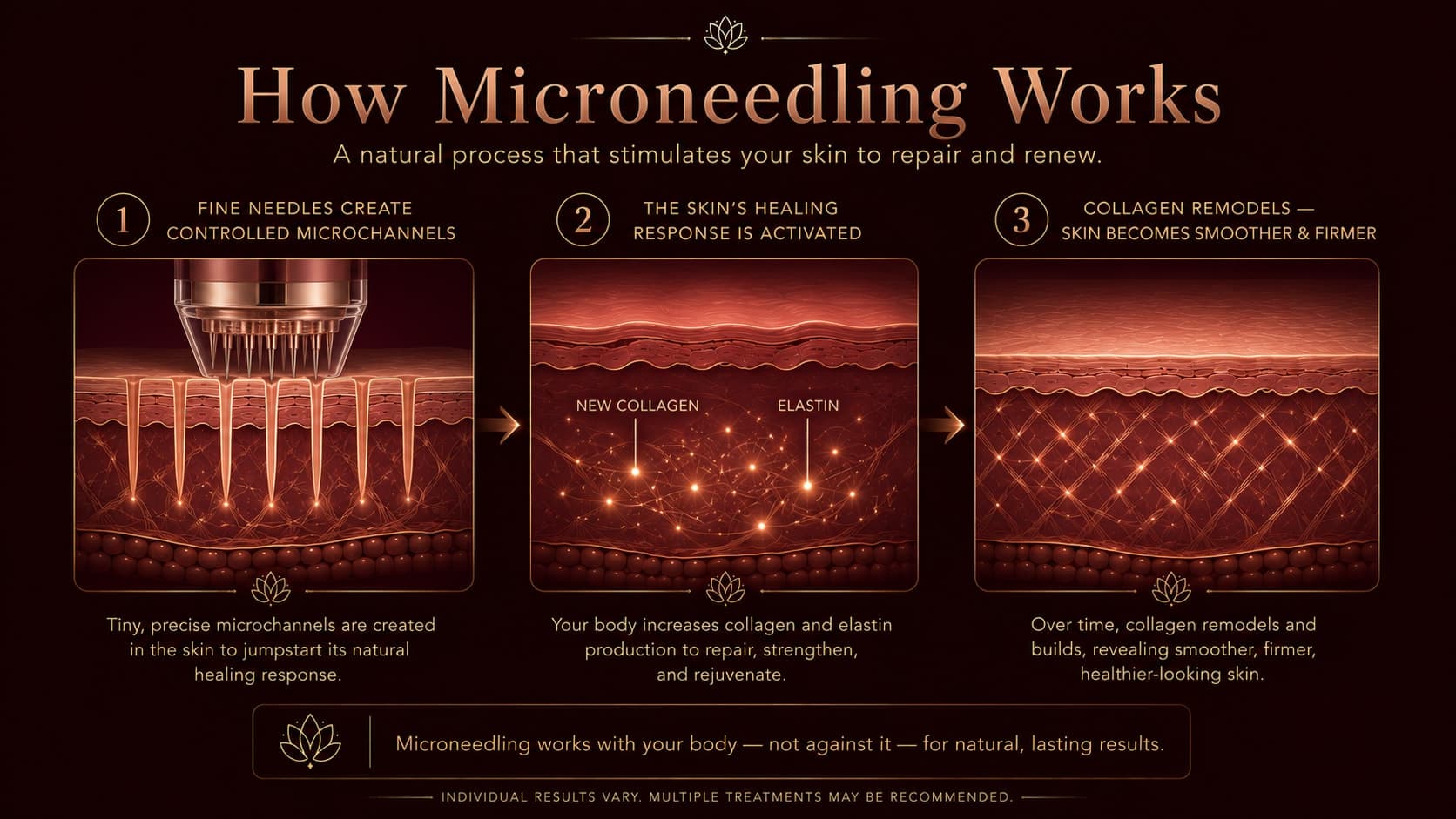 Illustration titled How Microneedling Works showing fine needles creating controlled microchannels in the skin, the body's healing response stimulating new collagen and elastin, and skin becoming smoother, firmer, and more even as collagen remodels.
