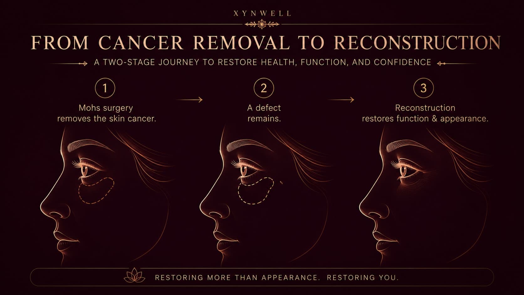 Illustration titled From Cancer Removal to Reconstruction showing the two-stage process in three steps on a stylized side profile: Mohs surgery removes the skin cancer, a defect remains, and reconstruction restores function and appearance.
