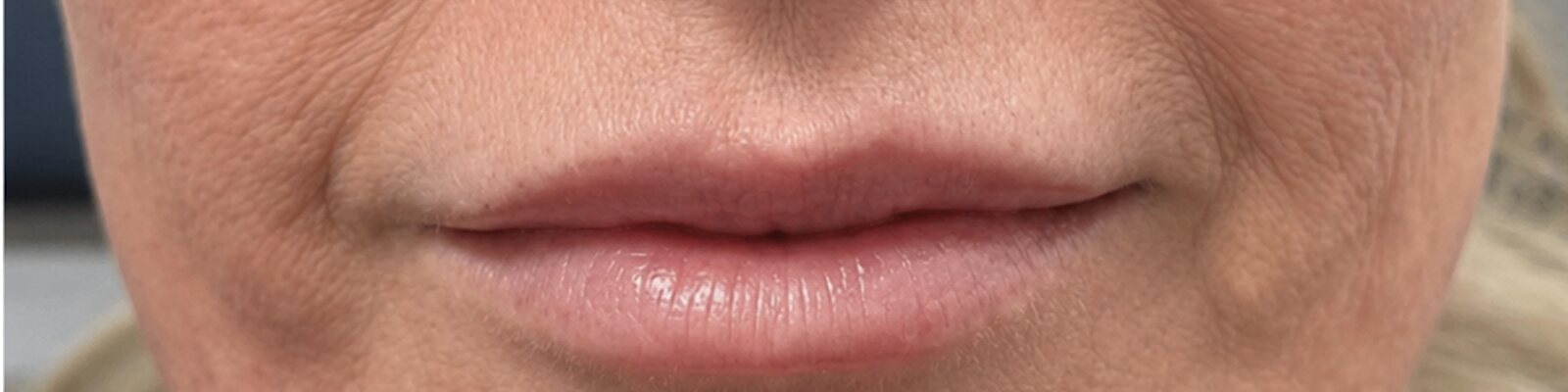 After lip lift — Enhanced lip definition and a more balanced, youthful appearance.