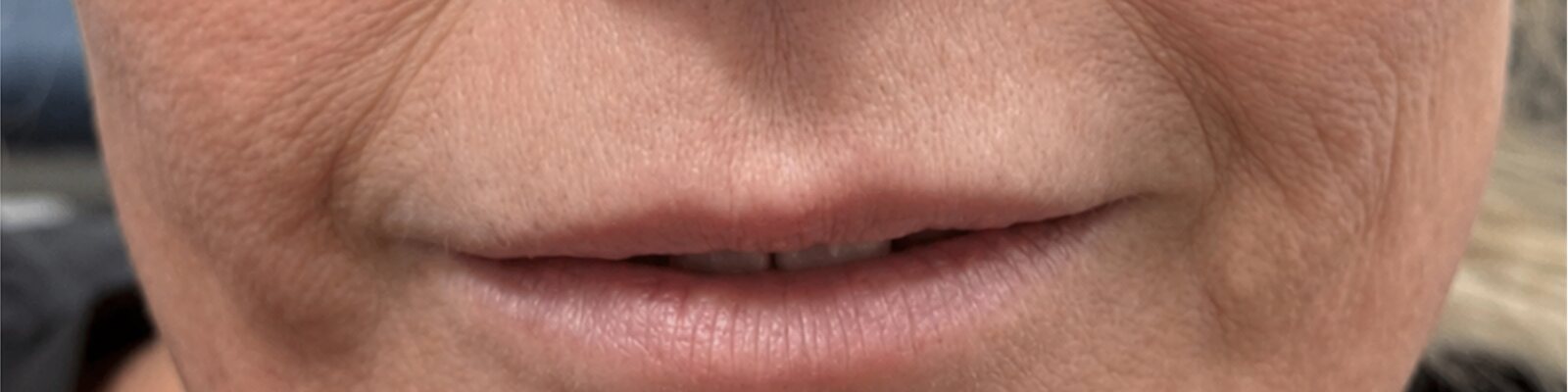 Before lip lift — Enhanced lip definition and a more balanced, youthful appearance.