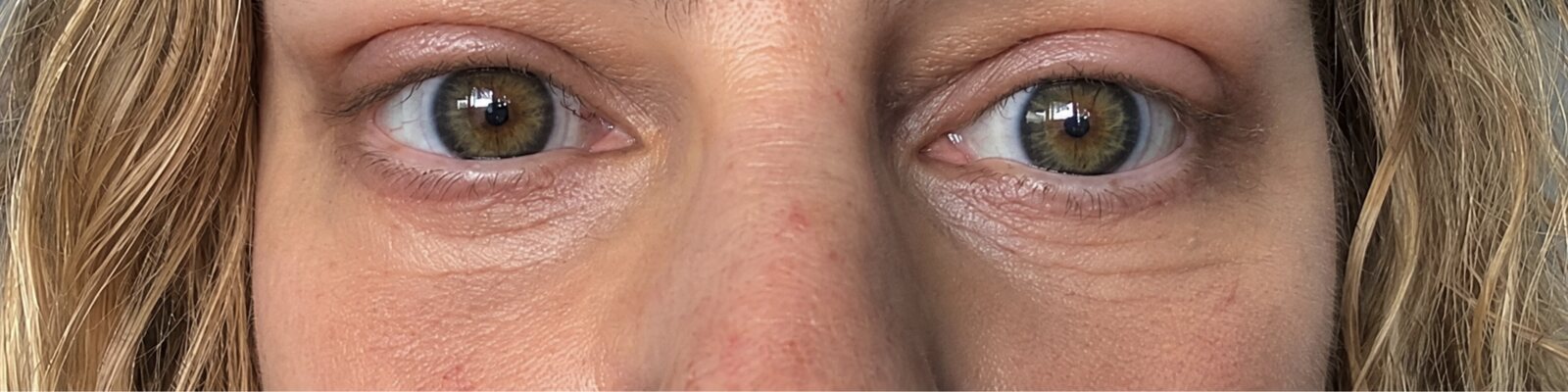 After lower blepharoplasty — Reduced under-eye bags and a smoother, more refreshed appearance.