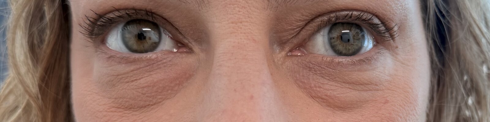 Before lower blepharoplasty — Reduced under-eye bags and a smoother, more refreshed appearance.