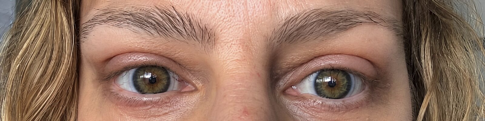 After upper blepharoplasty — Brighter, more open eyes with improved upper eyelid contour.