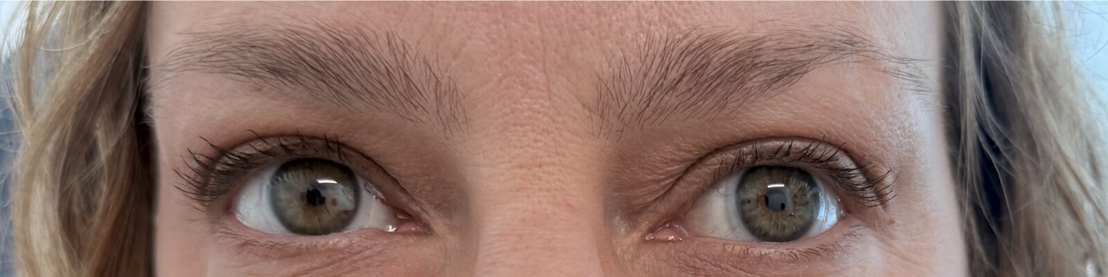 Before upper blepharoplasty — Brighter, more open eyes with improved upper eyelid contour.